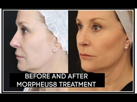 Preparations before undergoing Morpheus8: Essential steps to take