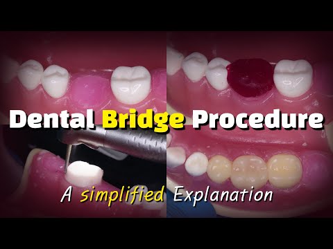 Understanding Bridgework: A Comprehensive Guide