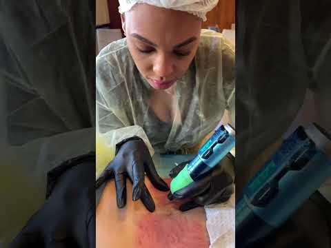 What Does Inkless Stretch Mark Removal Entail?