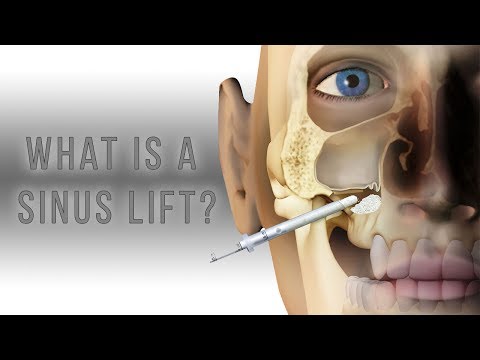 Understanding Sinus Lift Procedures