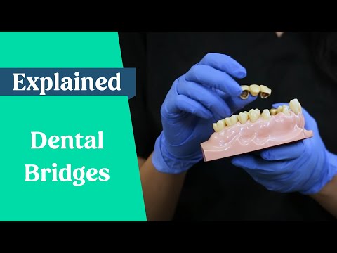 Understanding Bridgework: A Comprehensive Guide