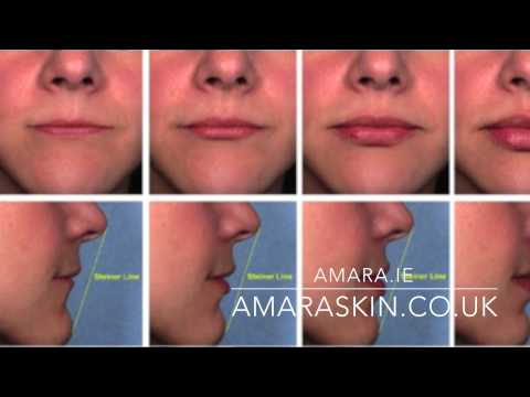 At what age are lip fillers available?