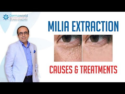 What is the underlying cause of milia formation around the eyes?