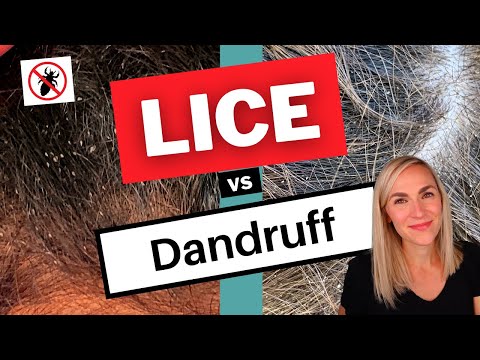 What is the appearance of nits on a paper towel?