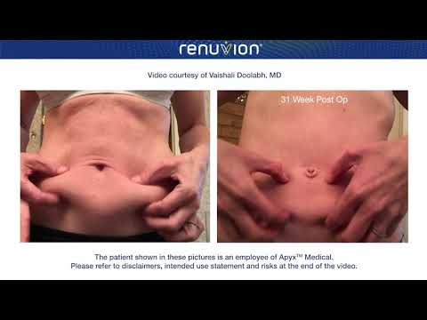 Understanding the Pre and Post Effects of J Plasma