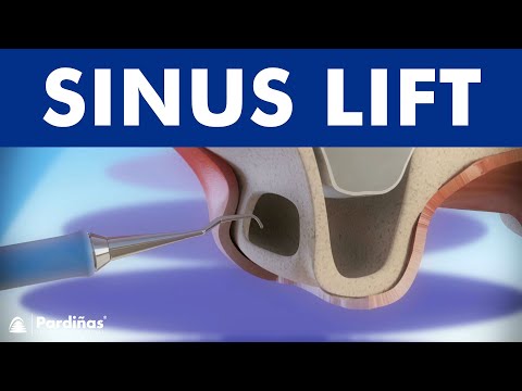 Explained: Understanding the Purpose and Procedure of a Sinus Lift