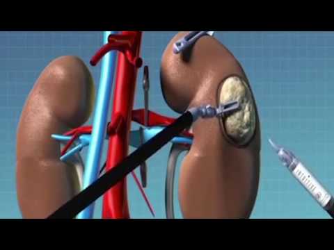 Understanding Kidney Cancer: A Comprehensive Overview