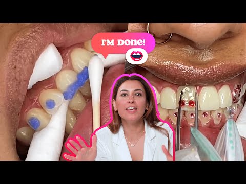 Which glue is the most effective for tooth gems?