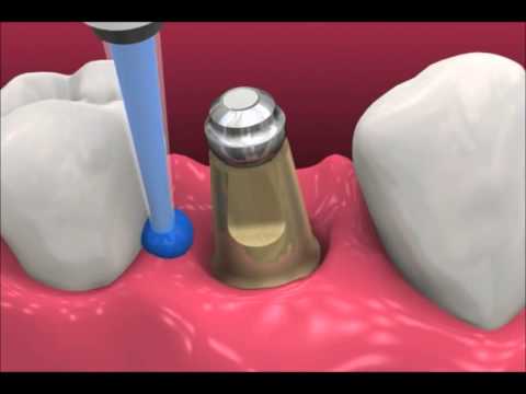 What is the appearance of dental implants?